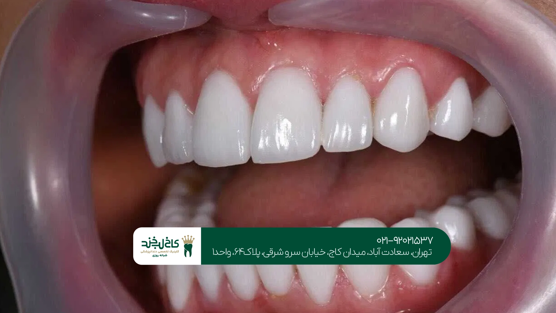 بهترین دندانپزشک لمینت دندان
