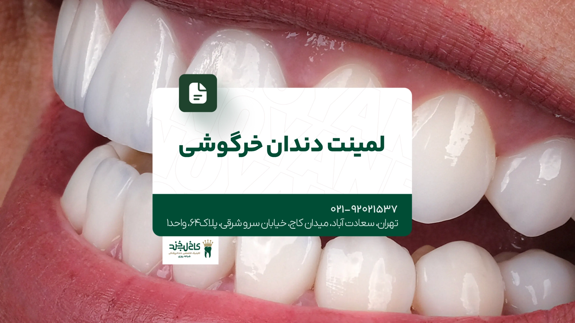 لمینت دندان خرگوشی لمینت دندان خرگوشی