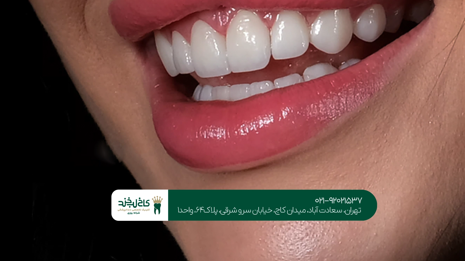 لمینت دندان در تهران لمینت دندان در تهران