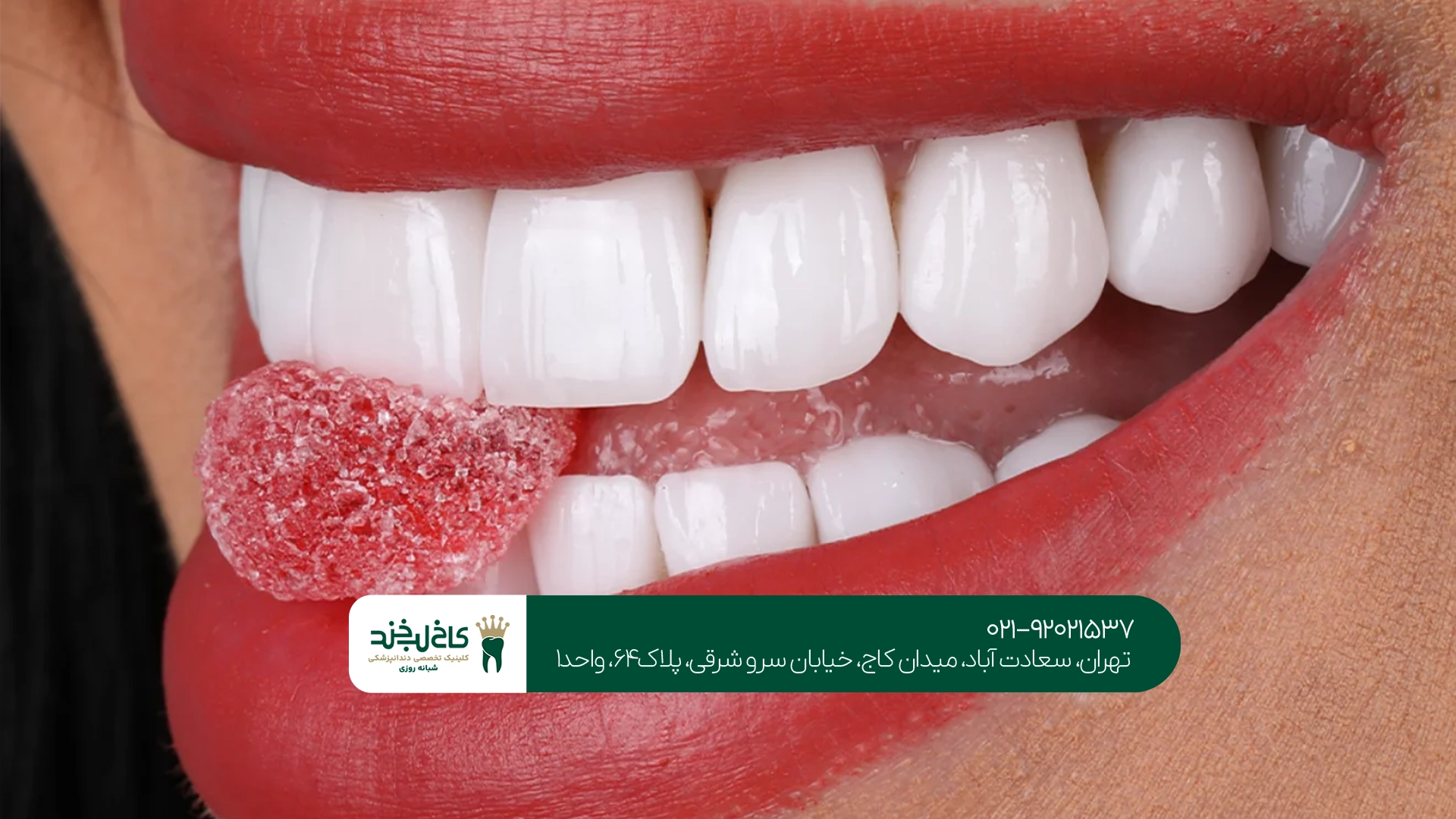 قیمت لمینت دندان خرگوشی قیمت لمینت دندان خرگوشی