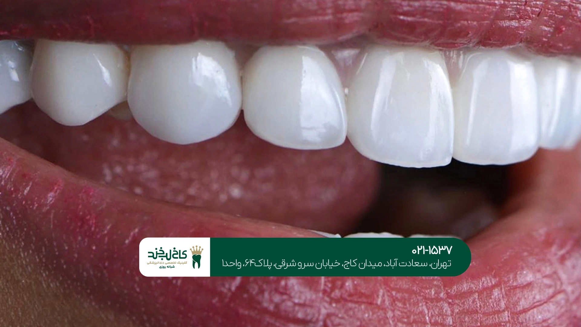 لمینت دندان طبیعی