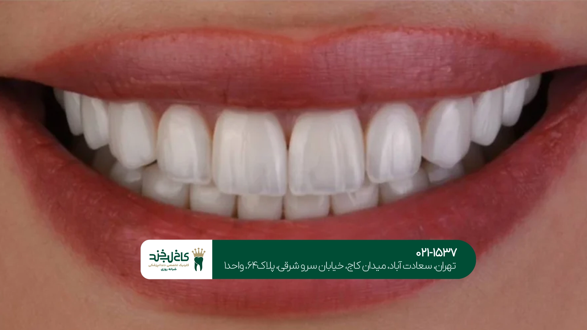 لمینت دندان طبیعی