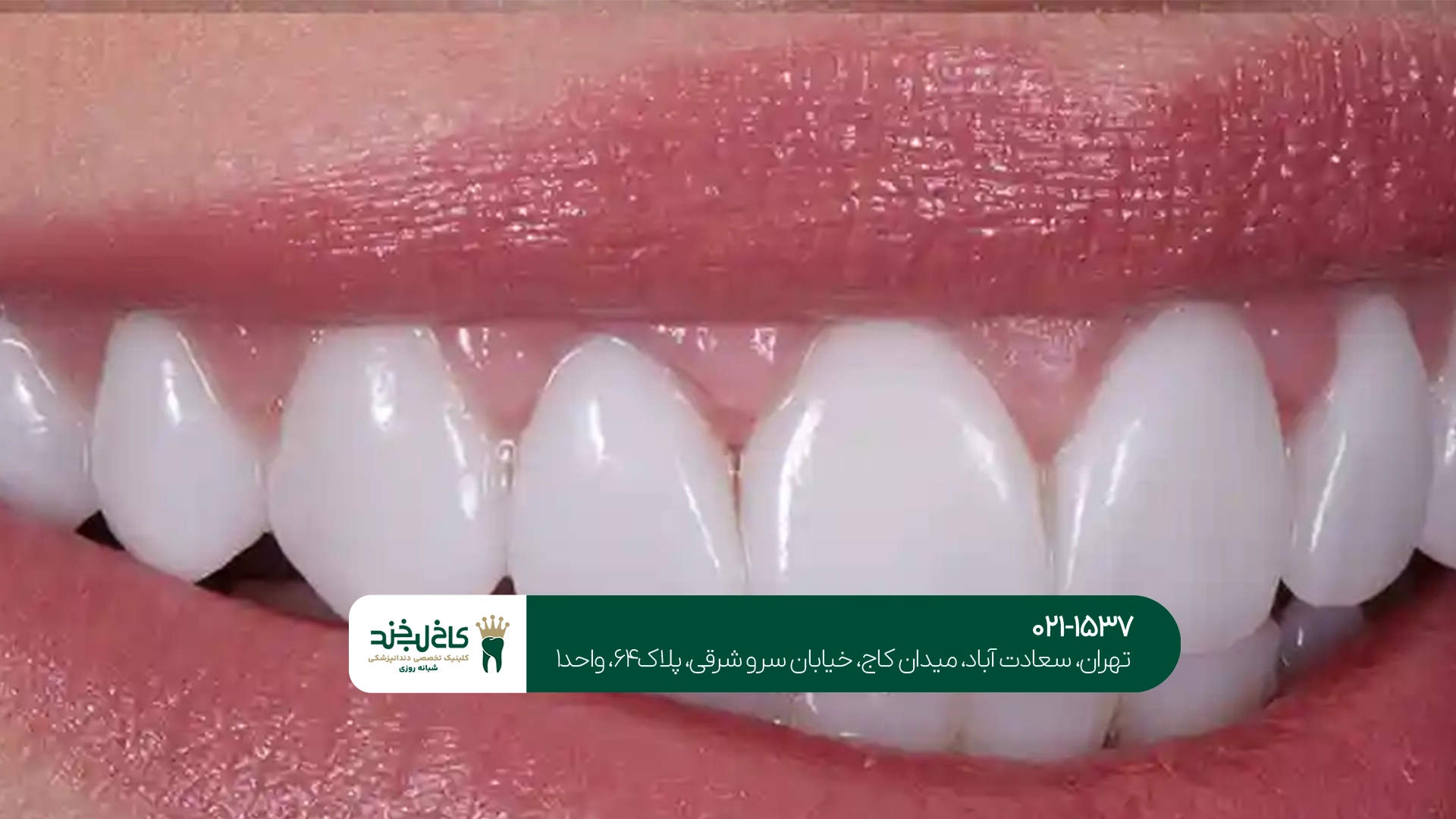 لمینت دندان طبیعی
