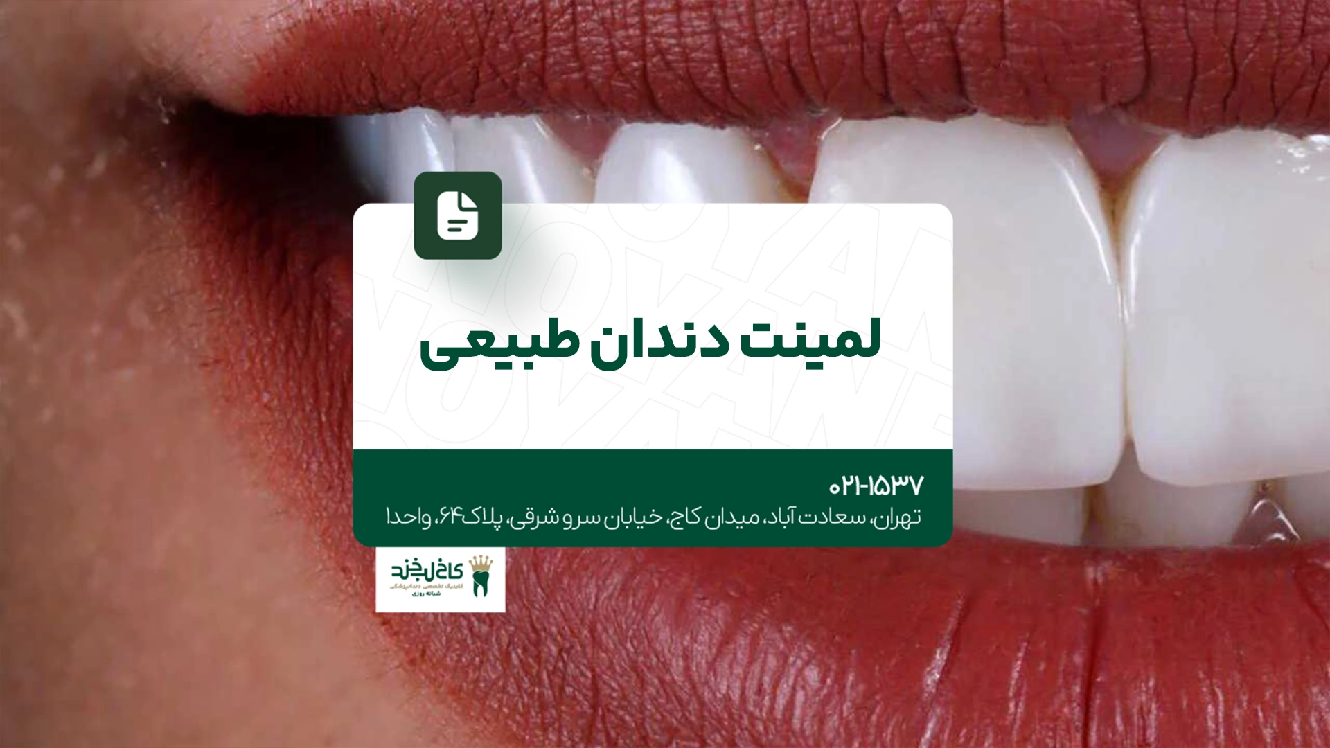 لمینت دندان طبیعی