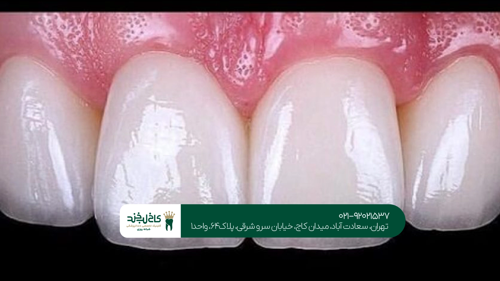 چه افرادی کاندیدای مناسب لمینت ایمکس هستند؟