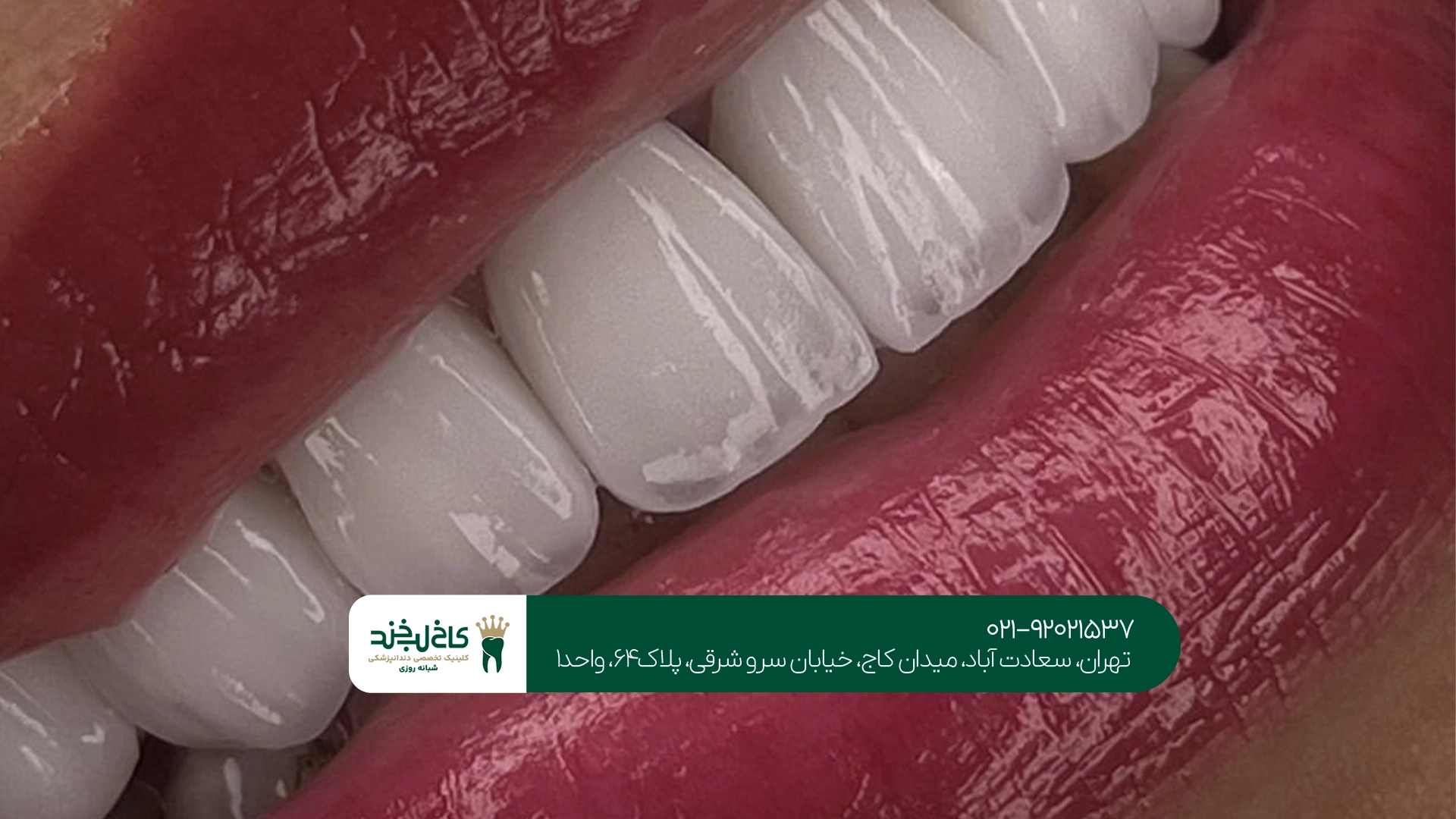 خدمات تخصصی لمینت سرامیکی
