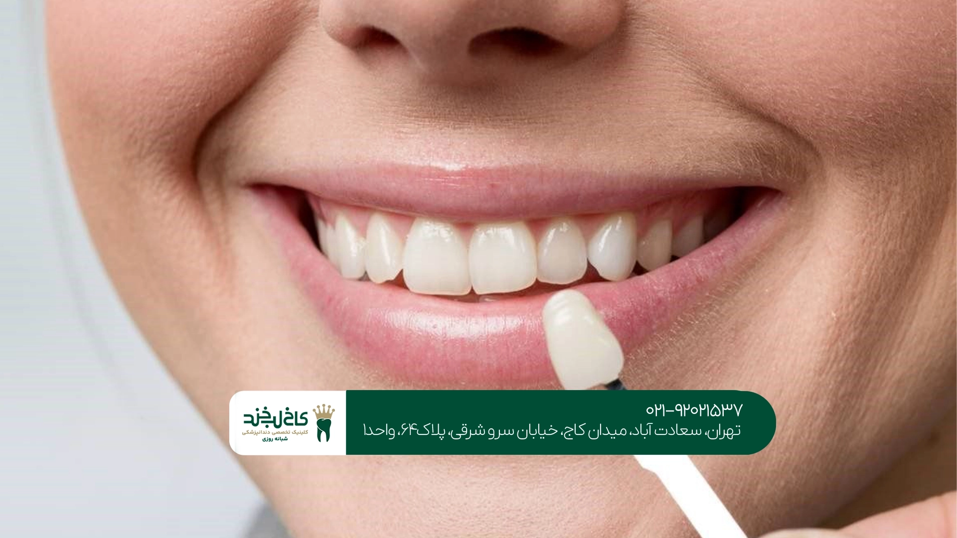 خدمات تخصصی لمینت دندان در سعادت آباد