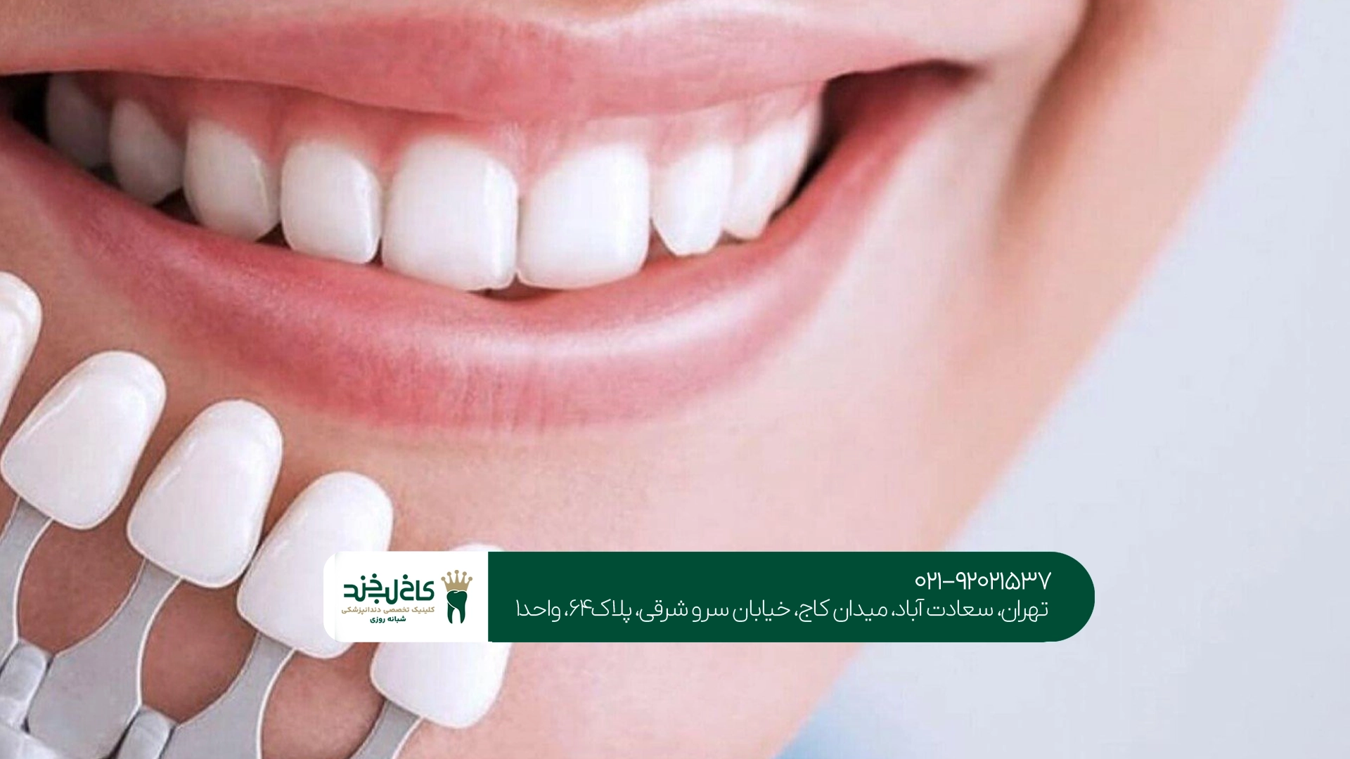 بهترین مرکز لمینت دندان در سعادت آباد