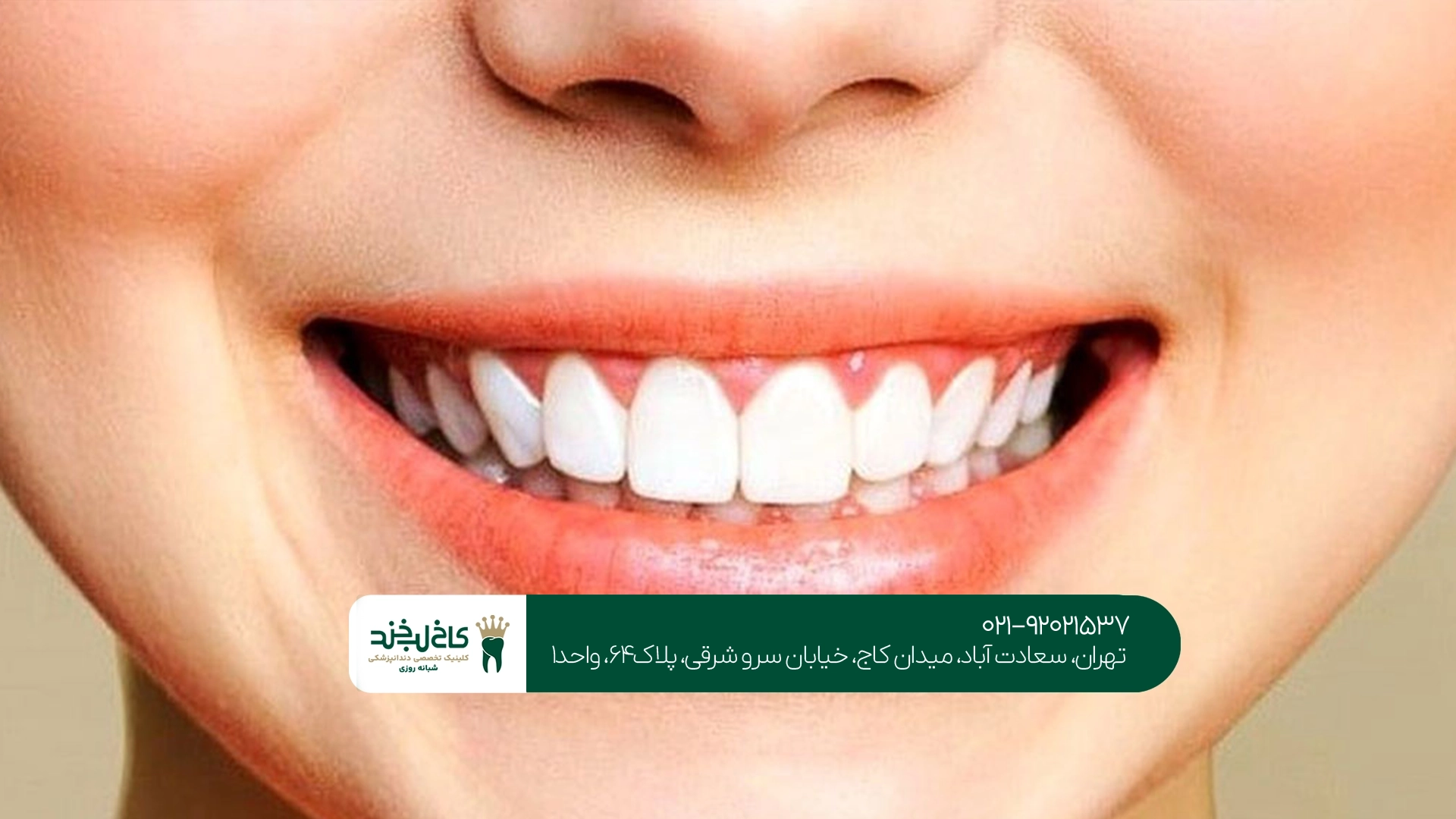بهترین مرکز لمینت دندان در سعادت آباد