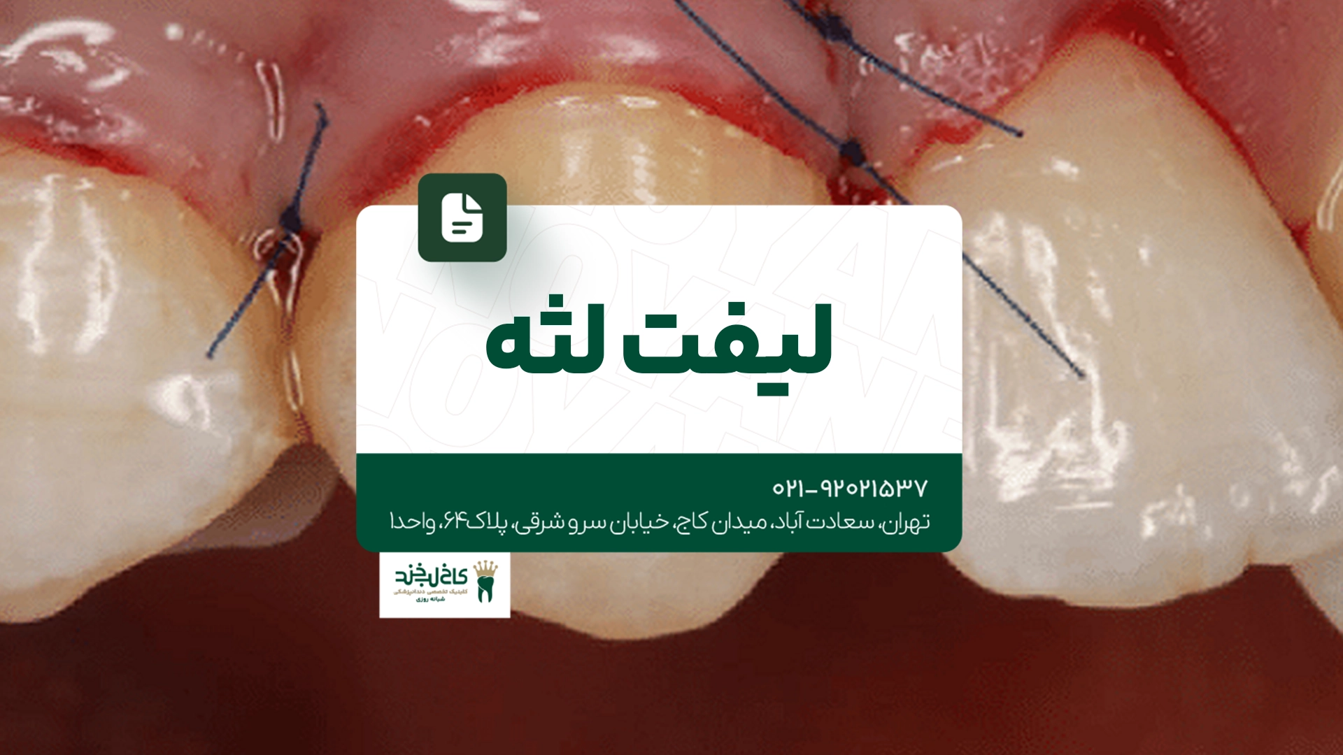 لیفت لثه
