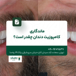 ماندگاری کامپوزیت دندان چقدر است