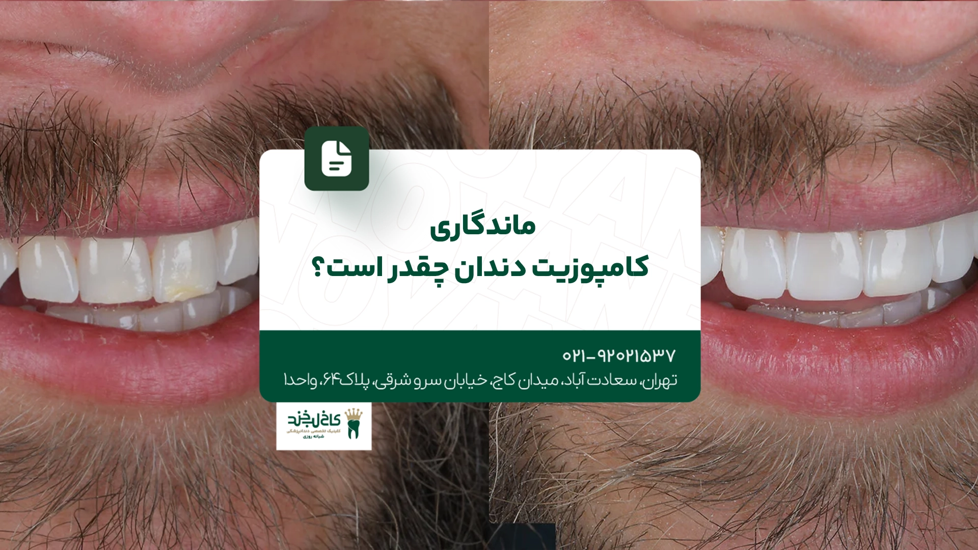 ماندگاری کامپوزیت دندان چقدر است
