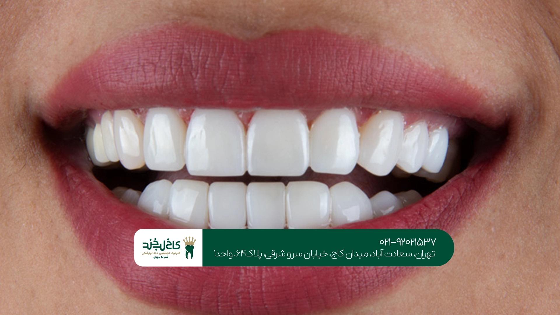 مرکز کامپوزیت دندان