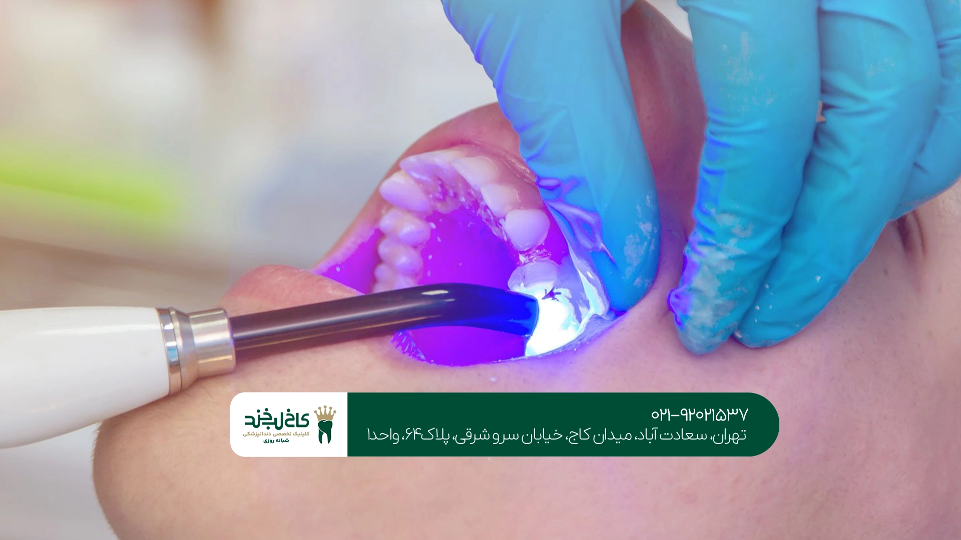 مقایسه ماندگاری کامپوزیت و لمینت