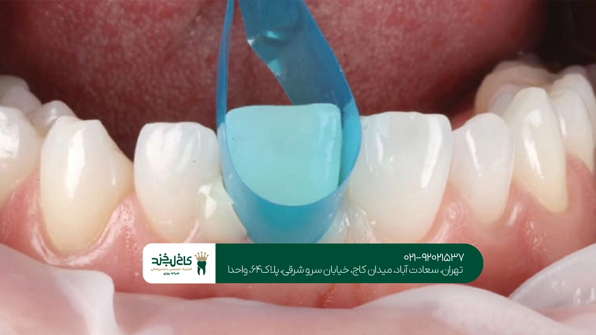 عوامل مؤثر بر طول عمر کامپوزیت دندان