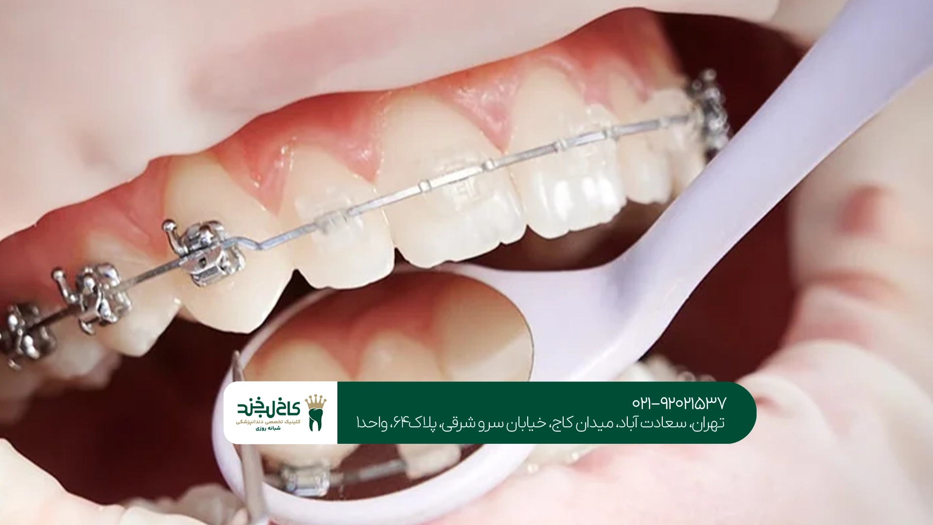 تفاوت ارتودنسی ثابت و متحرک
