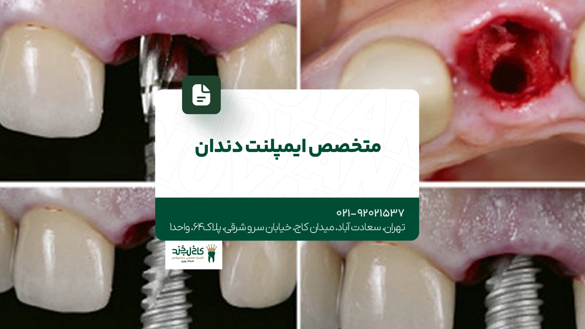 متخصص ایمپلنت دندان متخصص ایمپلنت دندان