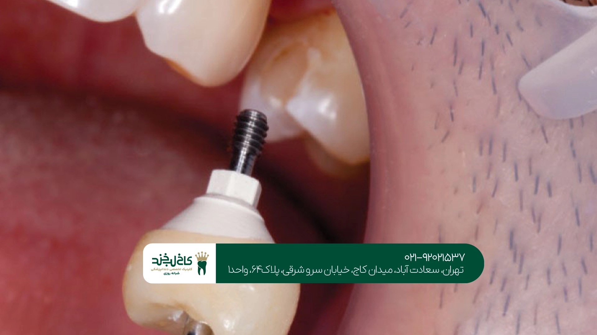 خدمات تخصصی ایمپلنت دندان خدمات تخصصی ایمپلنت دندان