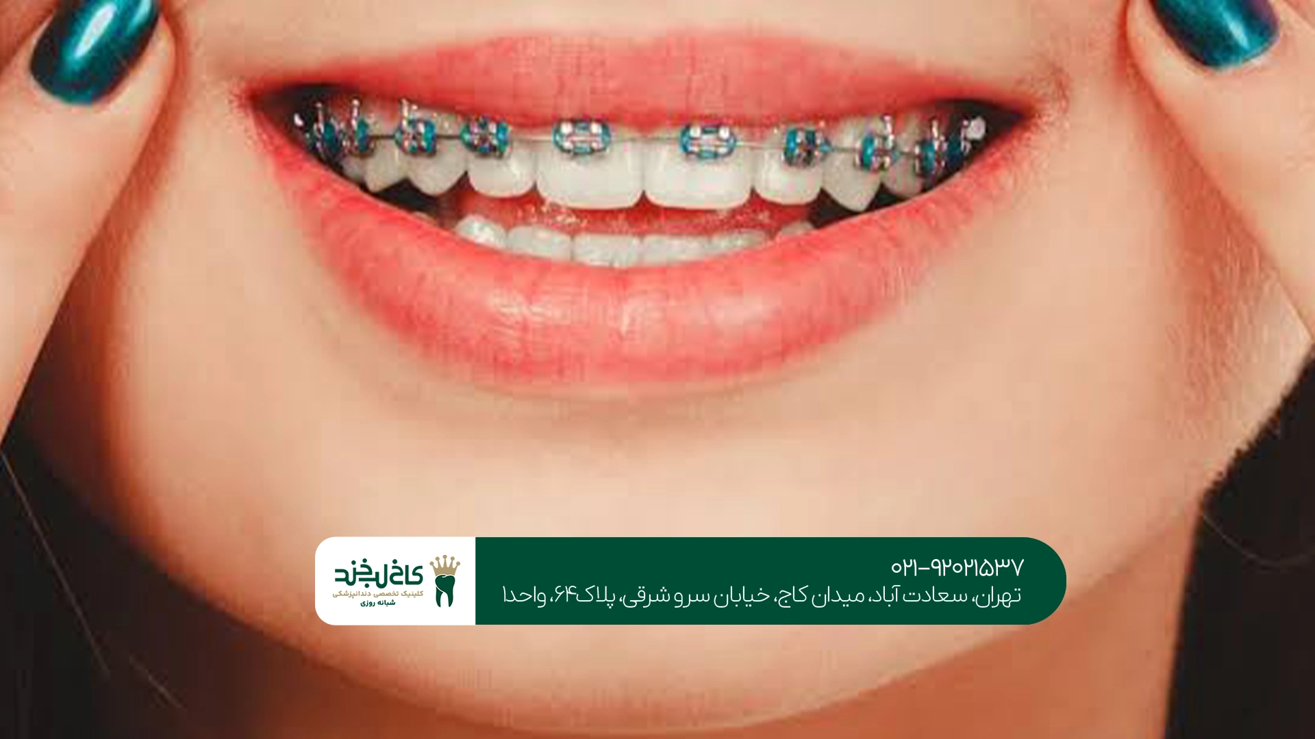 مدت زمان ارتودنسی نامرئی