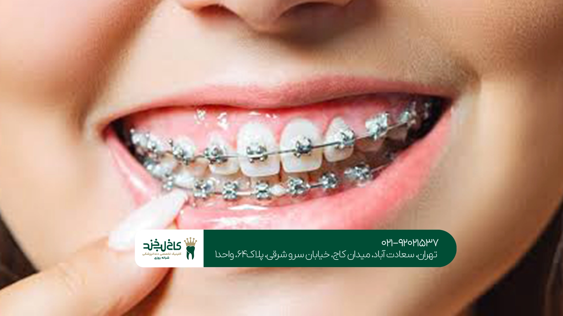 مدت زمان درمان ارتودنسی چقدر است