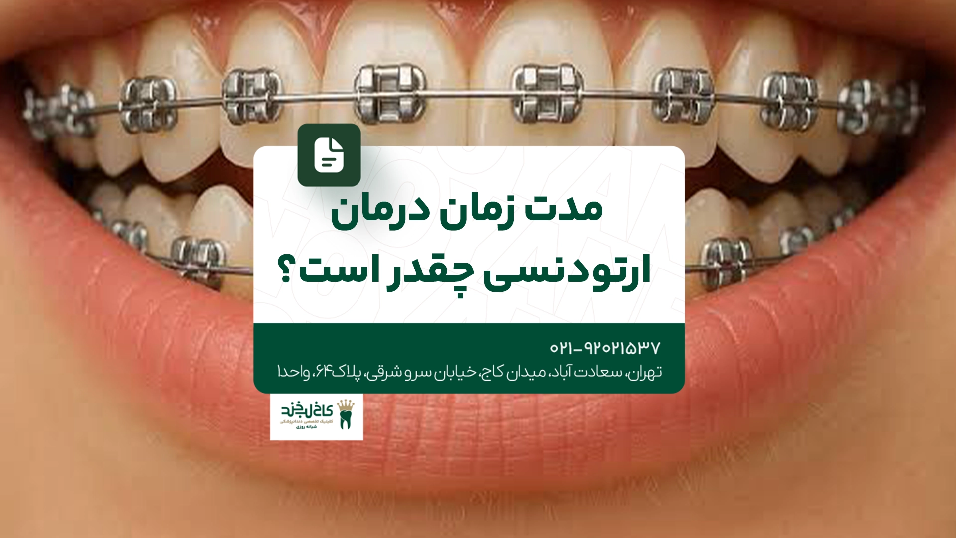 مدت زمان درمان ارتودنسی چقدر است