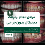 مراحل انجام ایمپلنت دیجیتال بدون جراحی