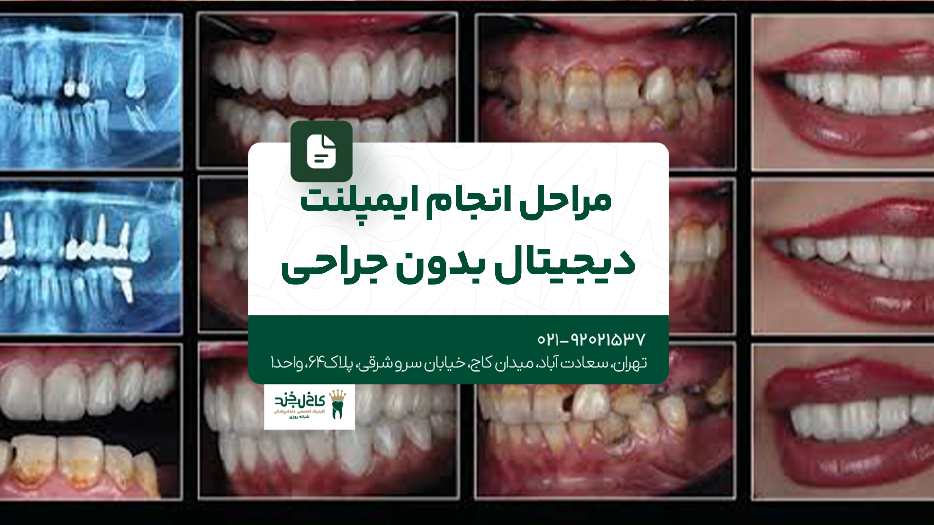 مراحل انجام ایمپلنت دیجیتال بدون جراحی