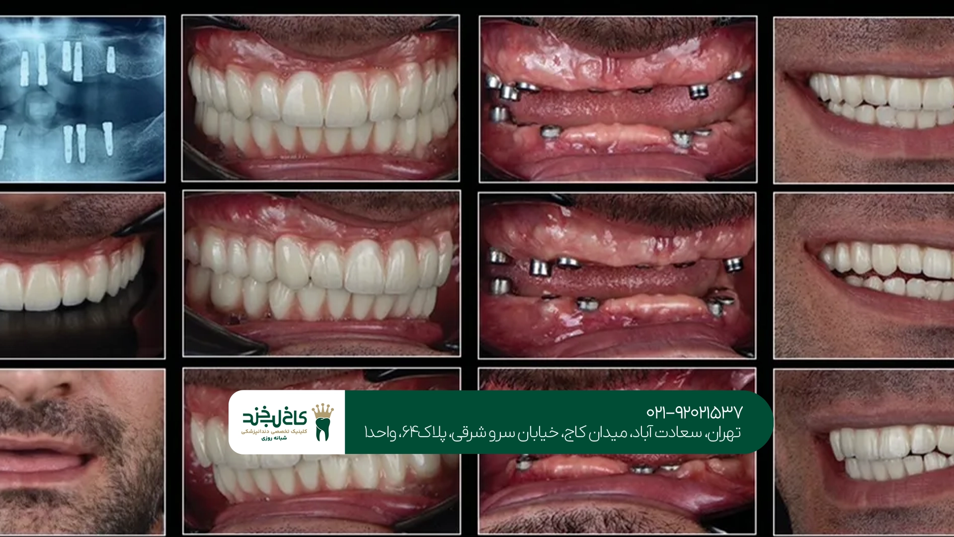 قیمت ایمپلنت دیجیتال