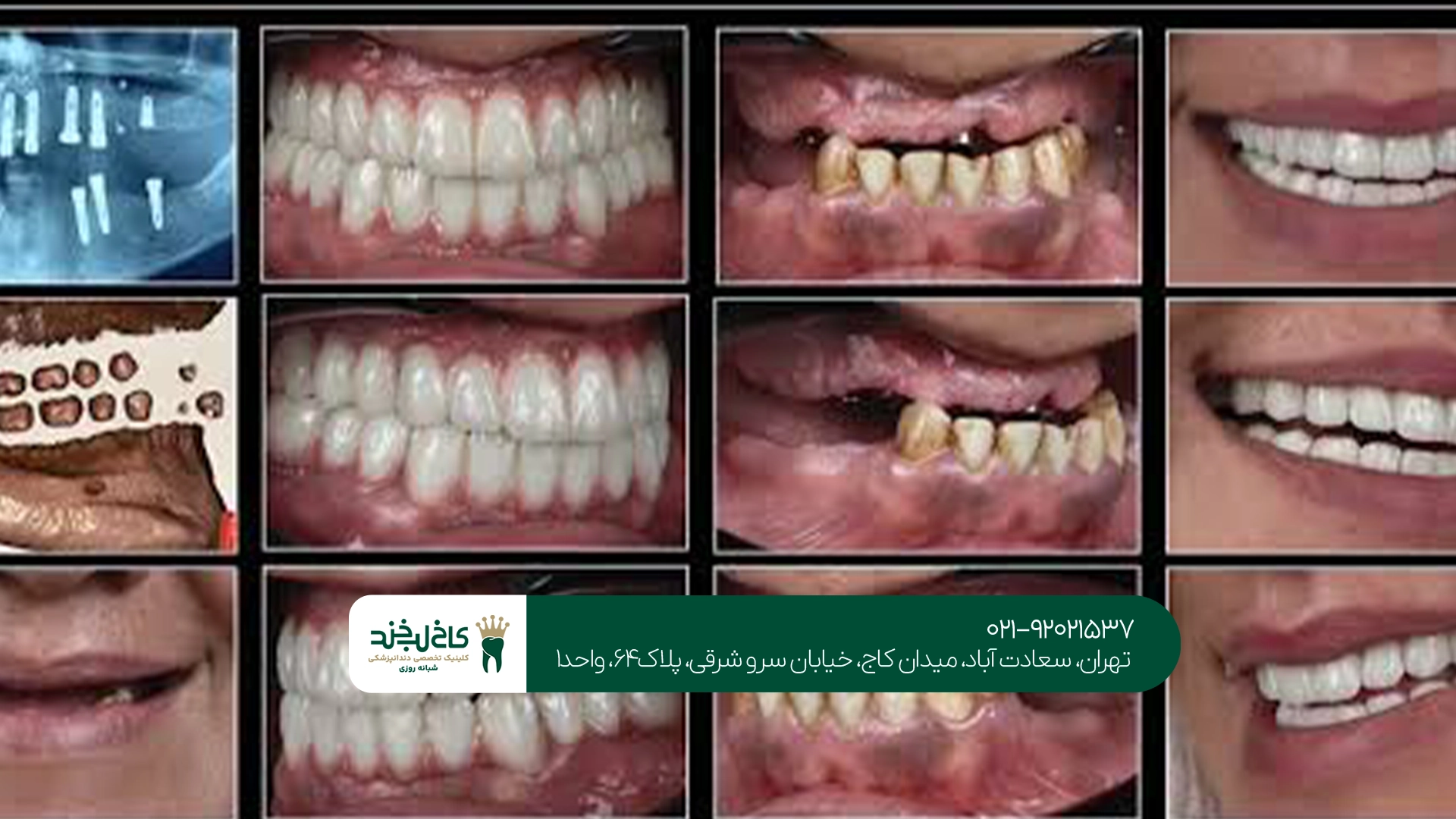 ایمپلنت بدون جراحی