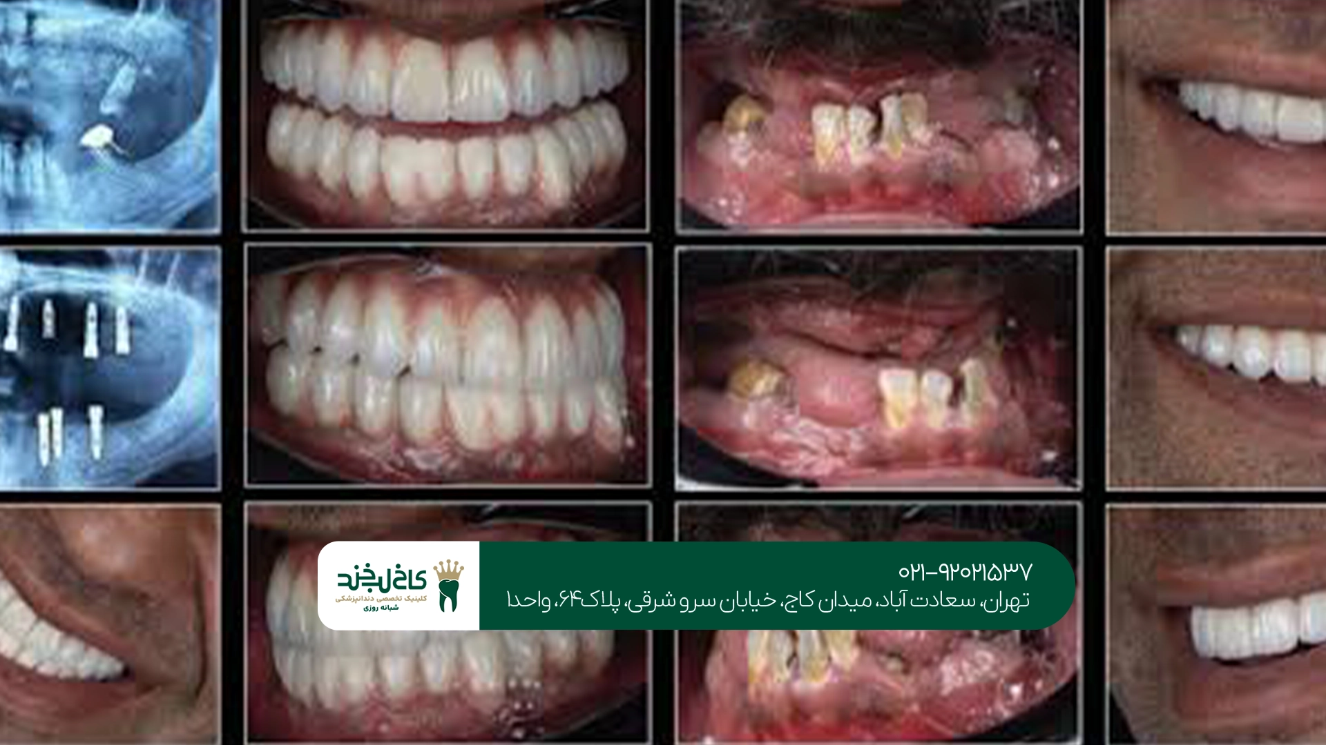 مزایای ایمپلنت دیجیتال بدون جراحی