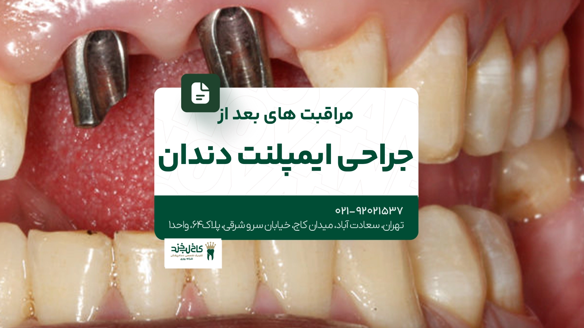 هزینه کاشت ایمپلنت دندان در سال جاری هزینه کاشت ایمپلنت دندان در سال جاری