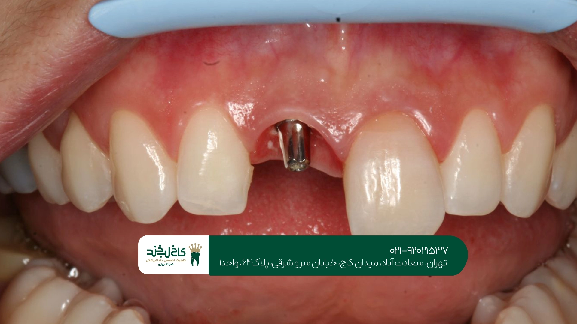 متخصص ایمپلنت دندان