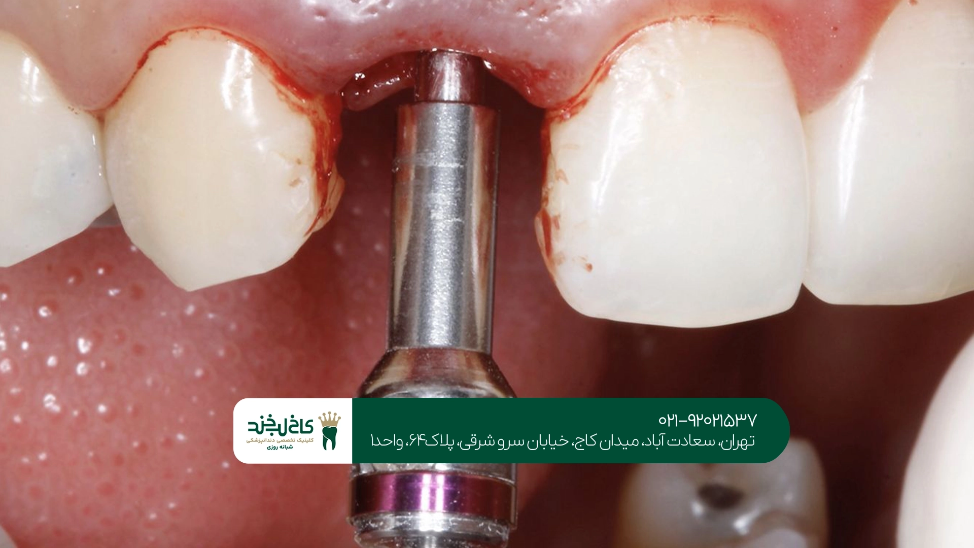 هزینه ایمپلنت دیجیتال دندان هزینه ایمپلنت دیجیتال دندان