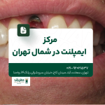مرکز ایمپلنت در شمال تهران