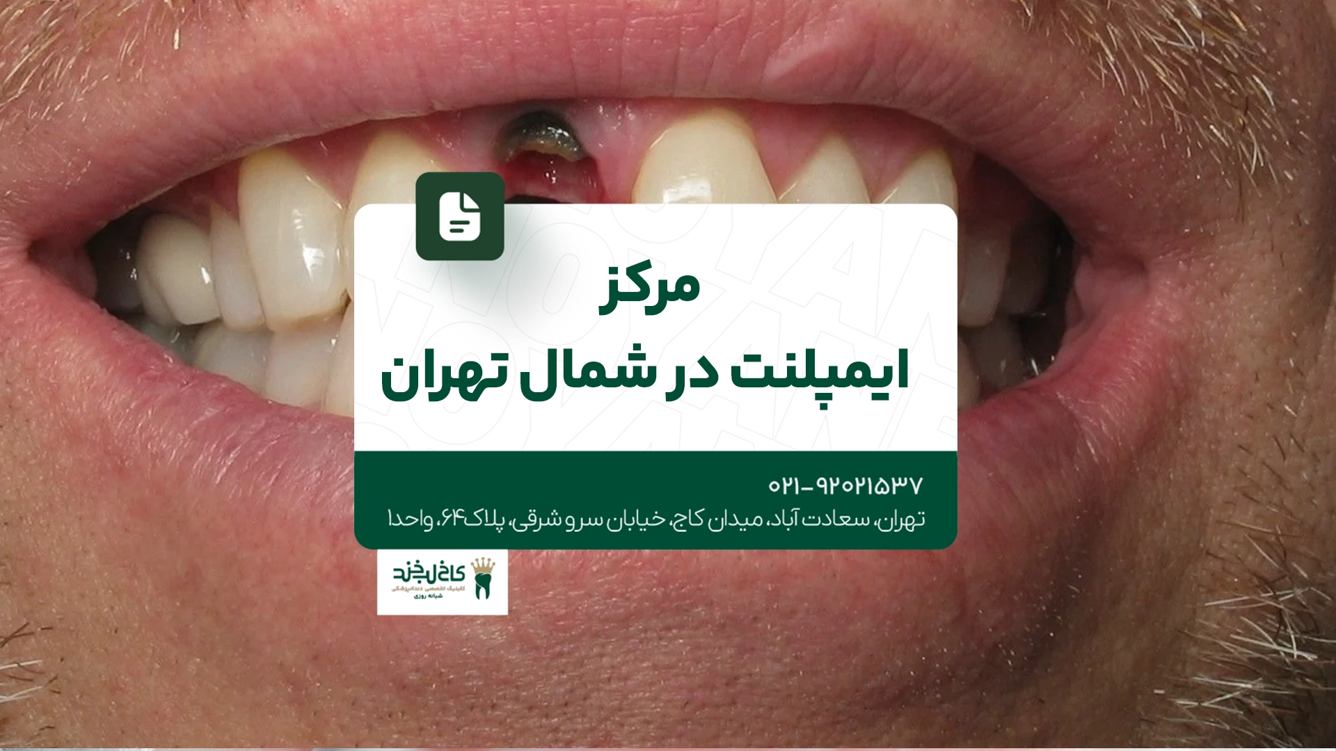 مرکز ایمپلنت در شمال تهران