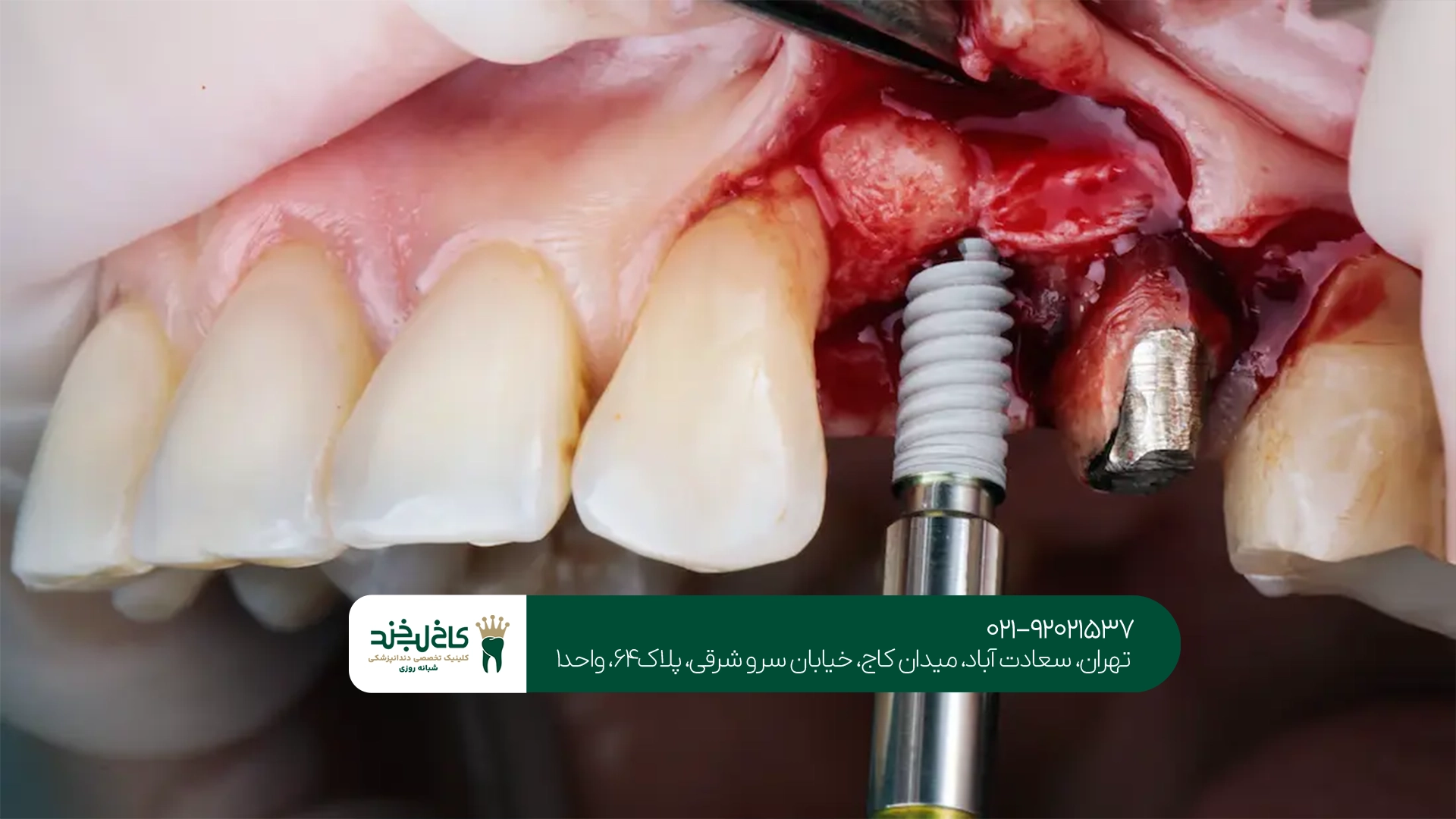خدمات ارائه شده در مرکز کاشت دندان تهران چیست؟