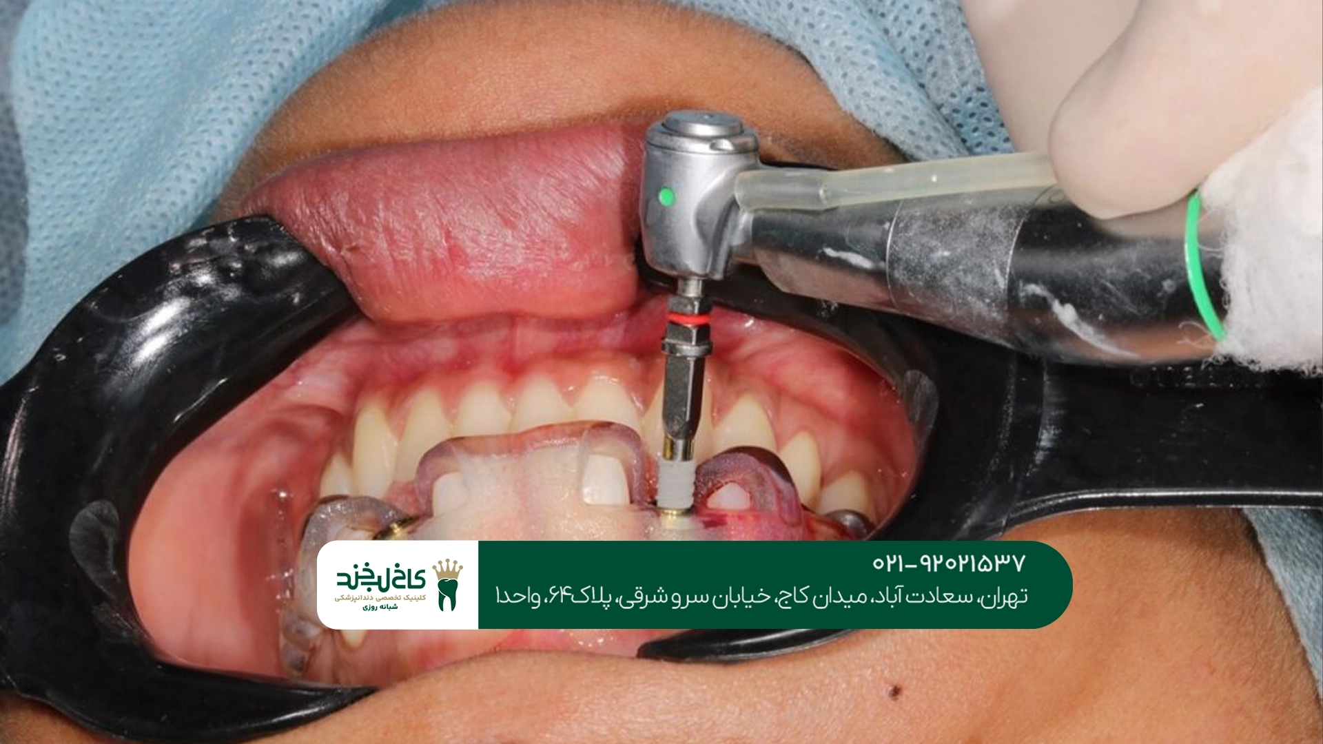 ایمپلنت دندان فوری