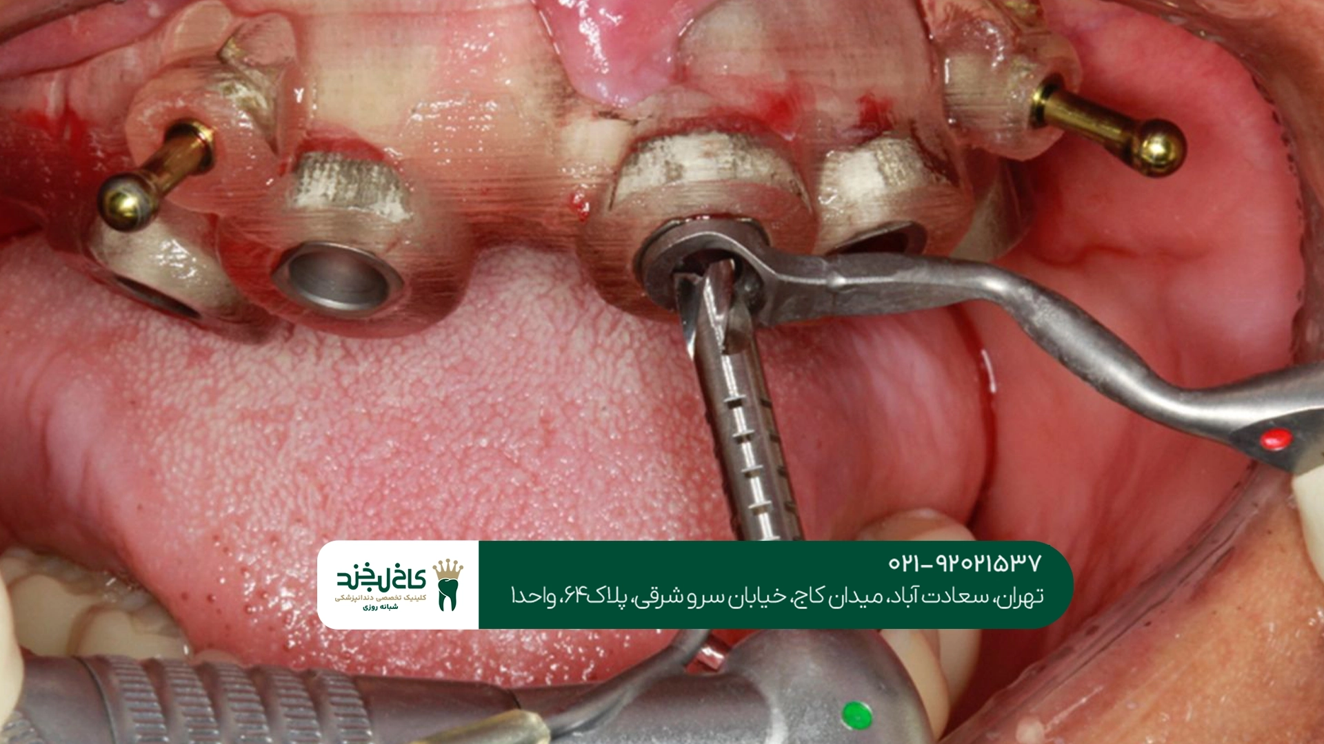 مرکز کاشت دندان