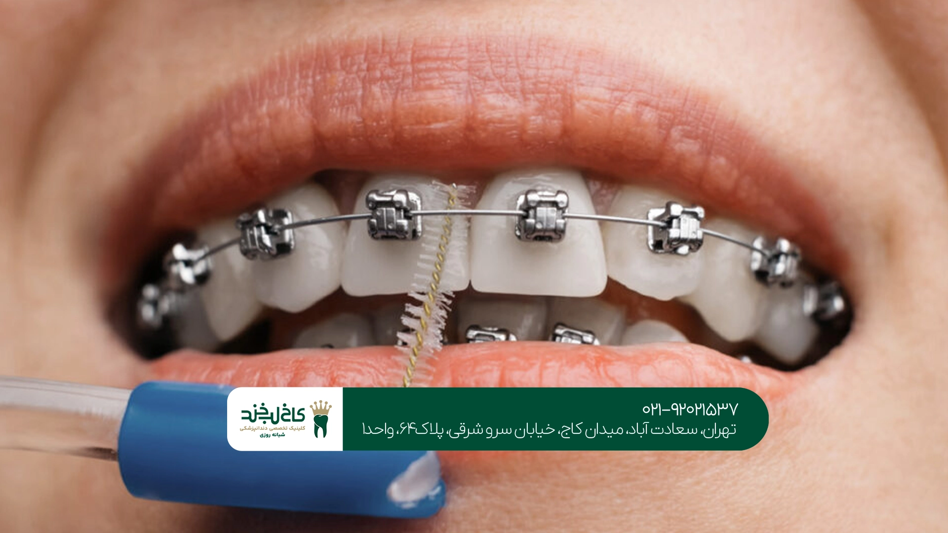 مسواک برای ارتودنسی مسواک برای ارتودنسی