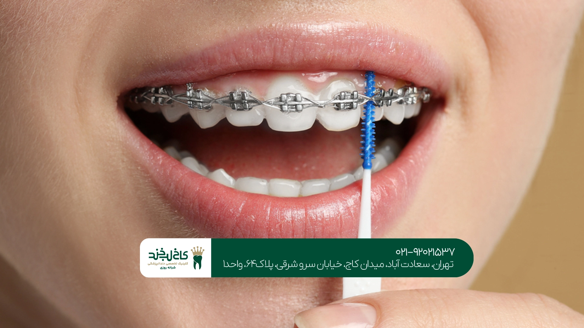 ارتودنسی شفاف در کلینیک ارتودنسی شفاف در کلینیک