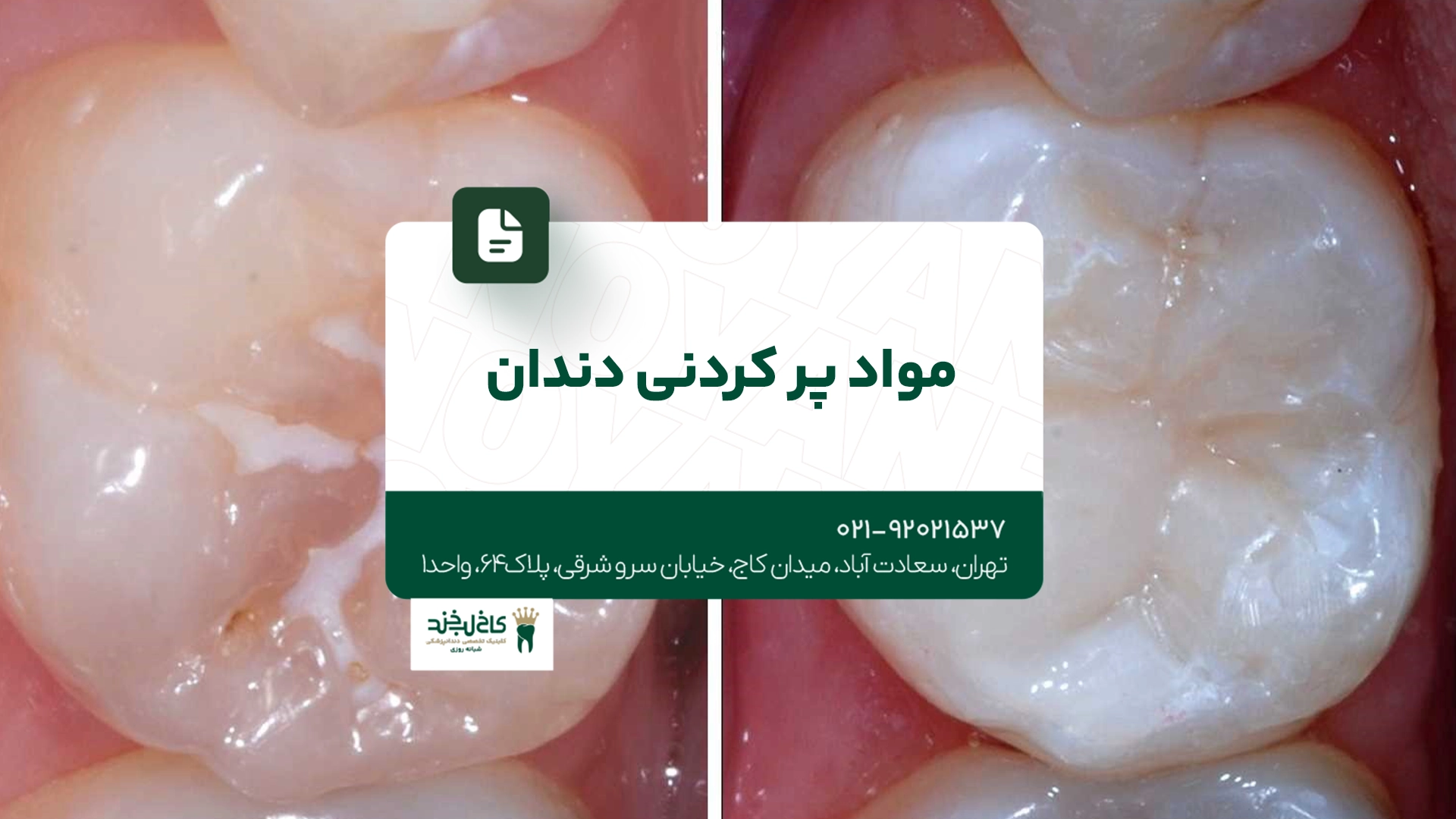 مواد پرکردنی دندان