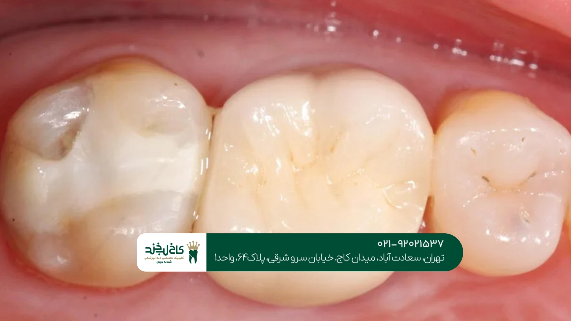 پر کردن دندان با مواد باکیفیت
