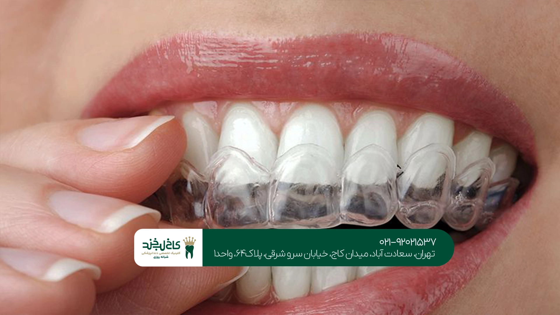 قیمت نایت گارد دندان قیمت نایت گارد دندان