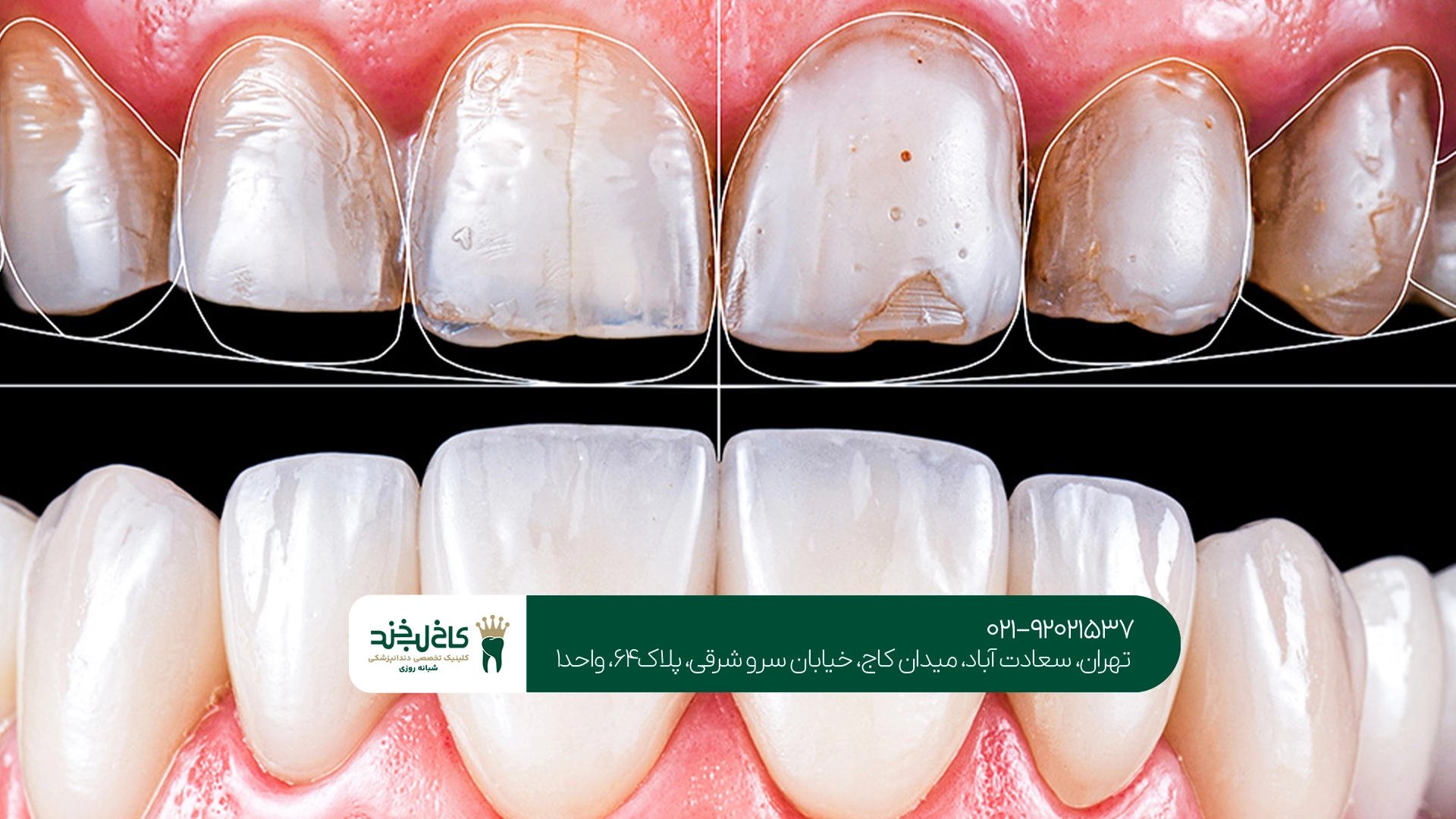 قیمت کامپوزیت دندان
