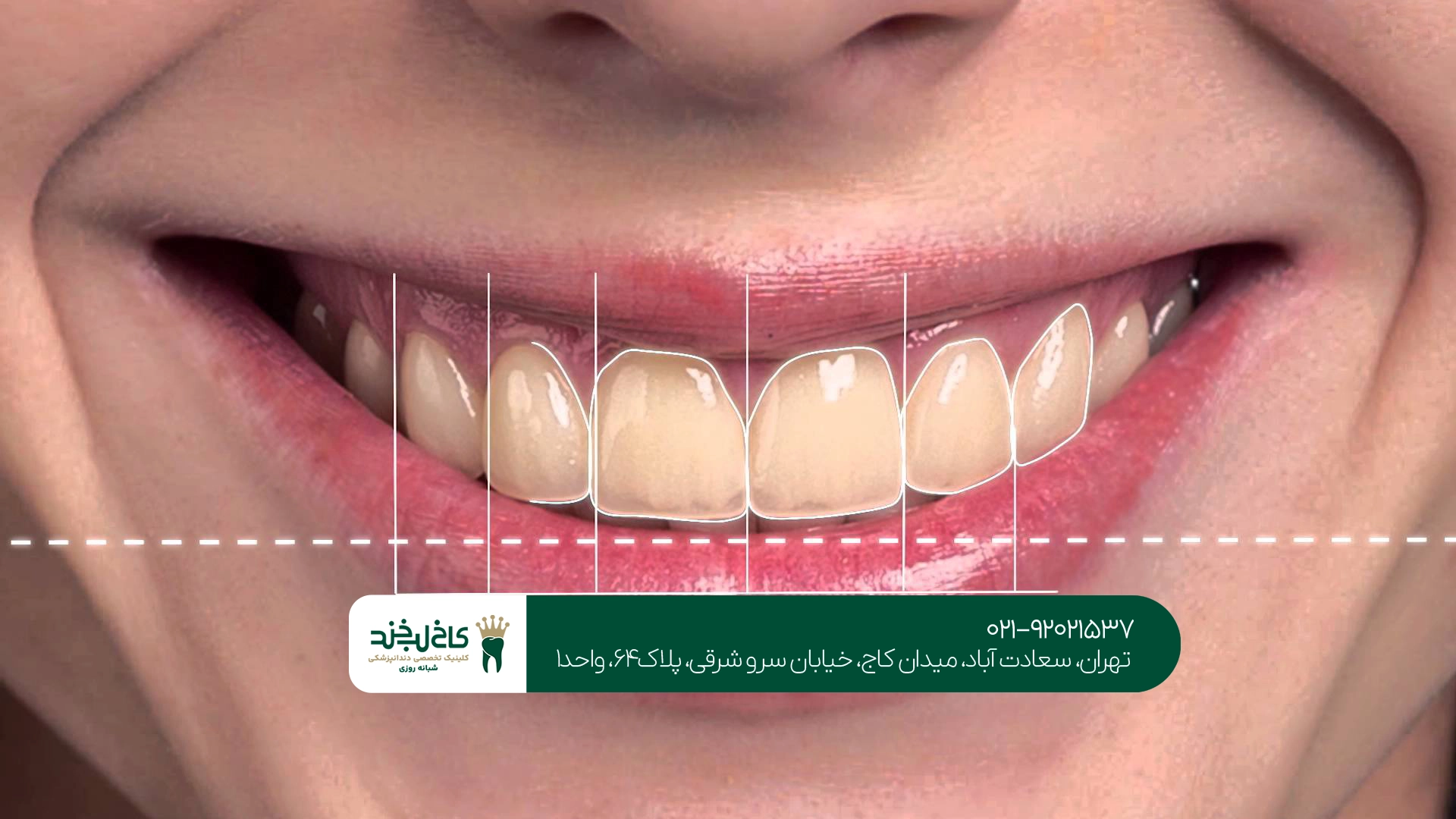 آیا تعداد دندانها بر هزینه کامپوزیت تأثیر میگذارد؟