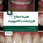 هزینه اصلاح طرح لبخند با کامپوزیت