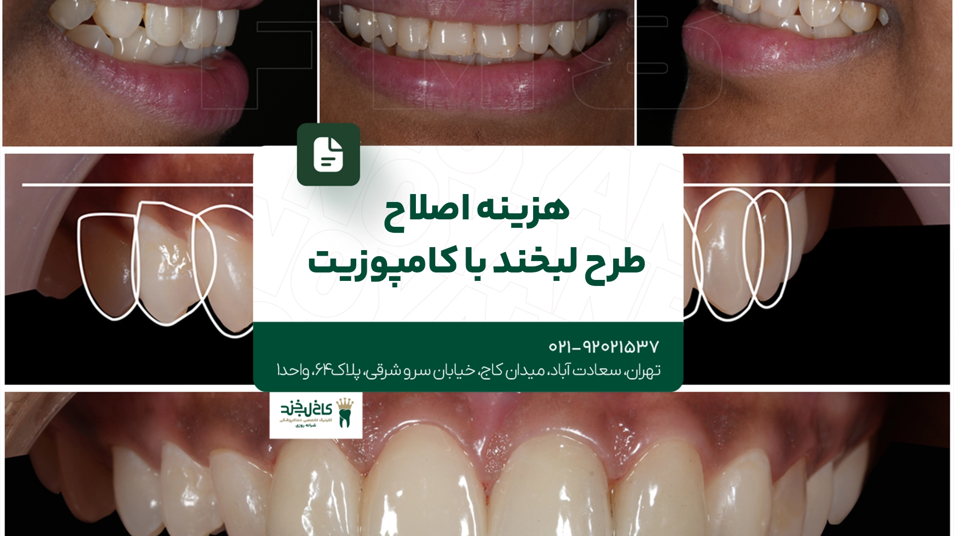 هزینه اصلاح طرح لبخند با کامپوزیت