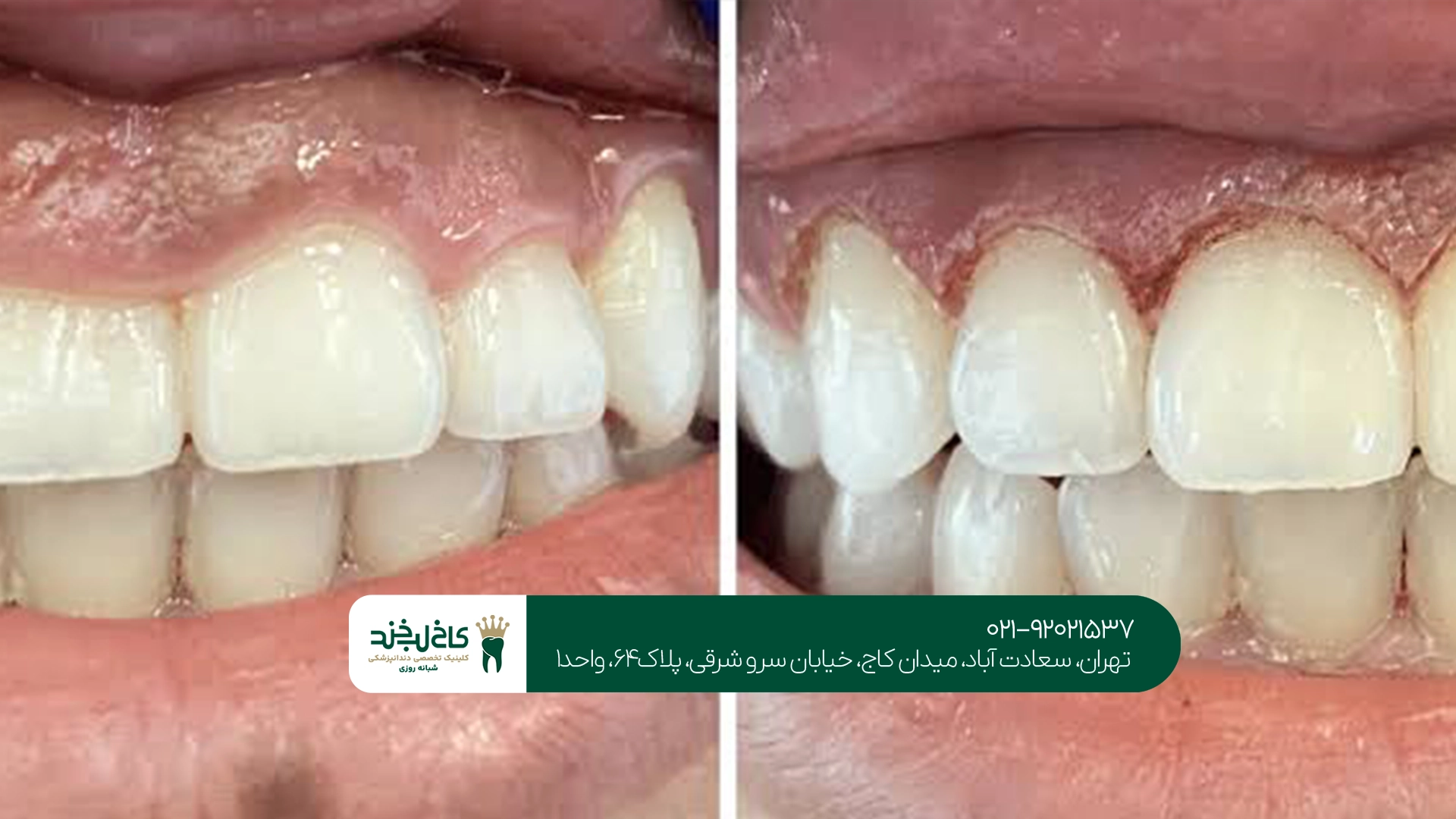 مراحل انجام جراحی لیفت لثه برای کامپوزیت دندان