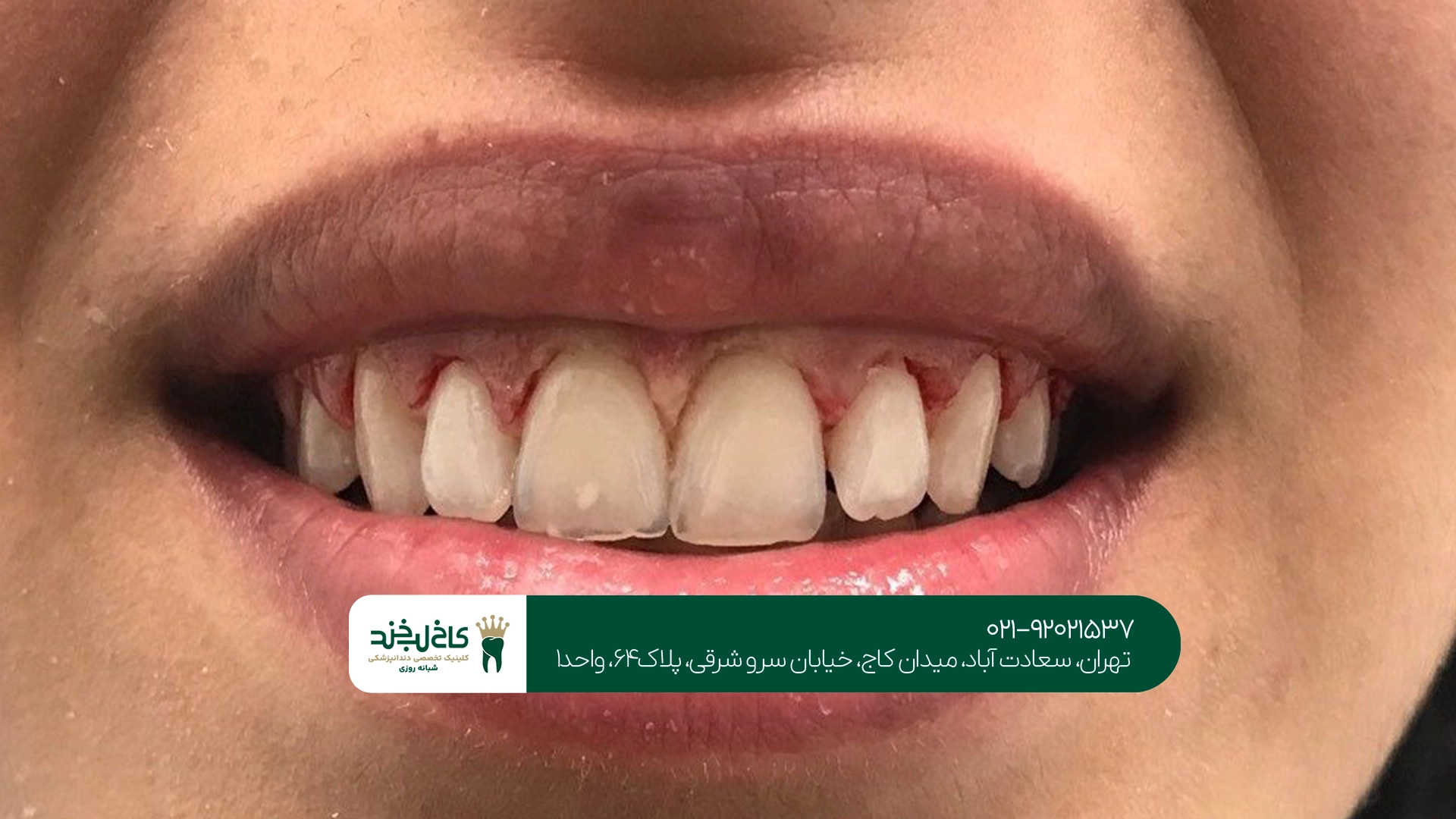 آیا لیفت لثه درد دارد؟
