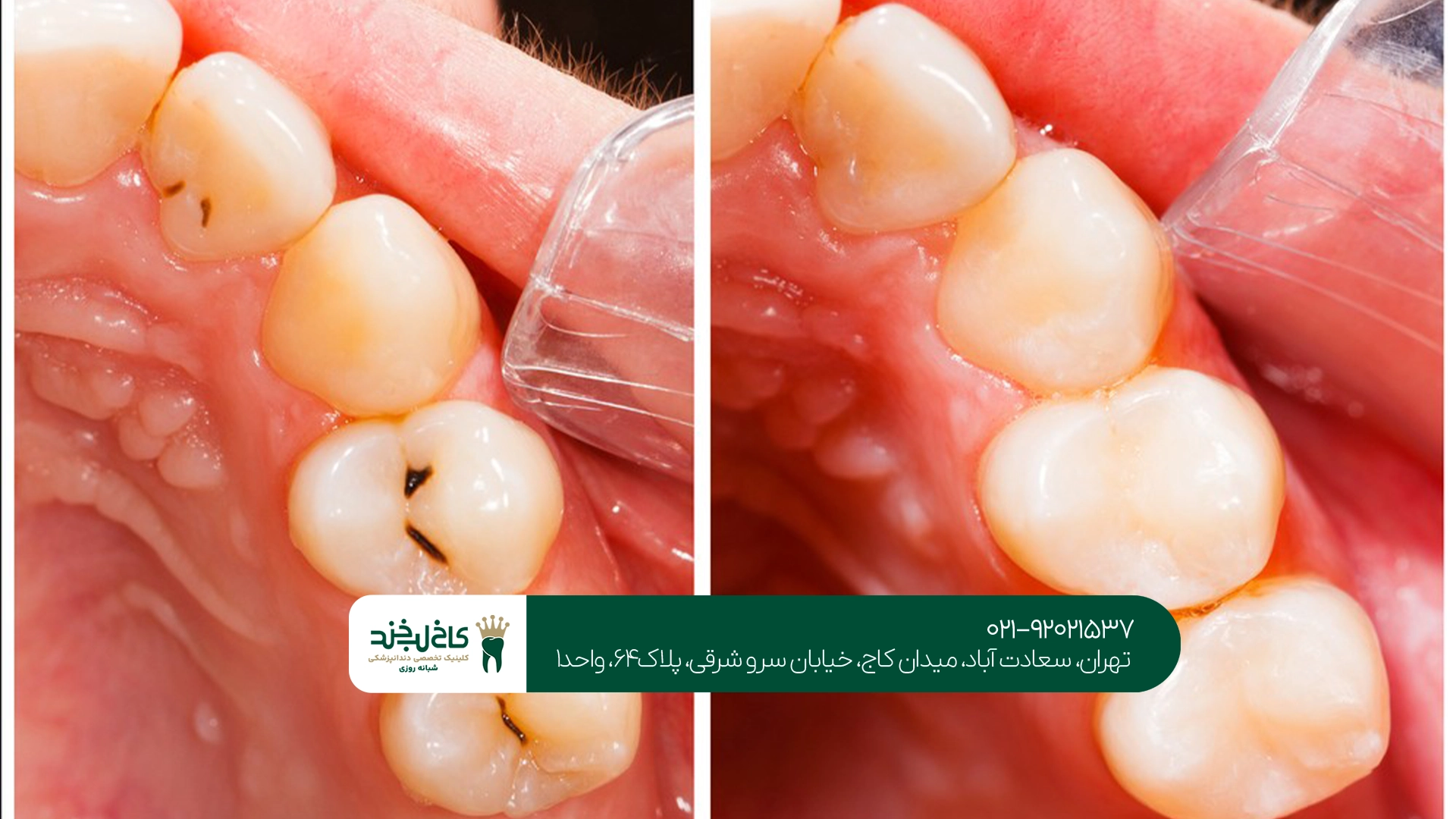 عصب کشی دندان در سعادت آباد